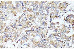 Immunohistochemistry of paraffin-embedded Human liver cancer using EIF3L Polyclonal Antibody at dilution of 1:100 (40x lens). (EIF3L antibody)