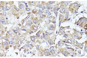 Immunohistochemistry of paraffin-embedded Human liver cancer using EIF3L Polyclonal Antibody at dilution of 1:100 (40x lens).