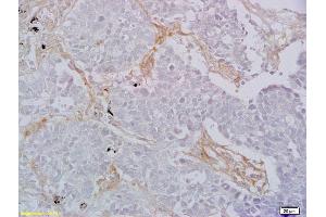 Formalin-fixed and paraffin embedded human lung carcinoma labeled with Rabbit Anti CD8 Polyclonal Antibody, Unconjugated (ABIN1385272) at 1:200 followed by conjugation to the secondary antibody and DAB staining (CD8 antibody  (AA 51-150))