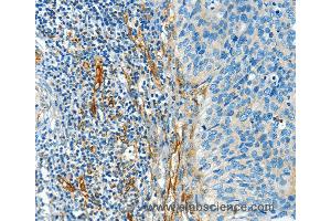 Immunohistochemistry of Human cervical cancer using DIO2 Polyclonal Antibody at dilution of 1:50 (DIO2 antibody)