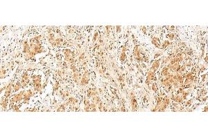 Immunohistochemistry of paraffin-embedded Human prost ate cancer tissue using RPS27A Polyclonal Antibody at dilution of 1:40(x200) (RPS27A antibody)