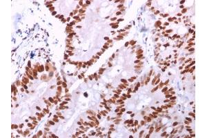 Formalin-fixed, paraffin-embedded human Colon Carcinoma stained with MCM6 Mouse Monoclonal Antibody (MCM6/2999). (MCM6 antibody  (AA 228-368))