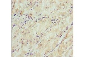 Immunohistochemistry of paraffin-embedded human gastric cancer using ABIN7171148 at dilution of 1:100 (SNAP29 antibody  (AA 1-258))