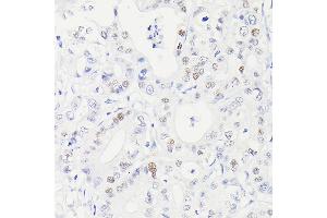 Immunohistochemistry (IHC) image for anti-Tumor Protein P53 (TP53) antibody (ABIN7271080)