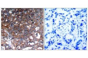 Immunohistochemical analysis of paraffin-embedded human breast carcinoma tissue, using IGF-1R (Ab-1346) antibody (E021303). (IGF1R antibody)
