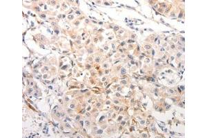 Immunohistochemical analysis of paraffin-embedded Human breast cancer tissue using. (Keratin 6C antibody  (Internal Region))