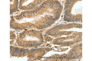 Immunohistochemistry of Human ovarian cancer using S100A4 Polyclonal Antibody at dilution of 1:80 (s100a4 antibody)