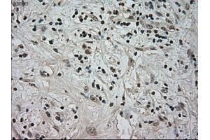 Immunohistochemical staining of paraffin-embedded Carcinoma of kidney tissue using anti-NTRK3mouse monoclonal antibody. (NTRK3 antibody)
