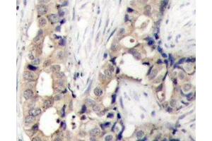 Immunohistochemistry of paraffin-embedded Human breast carcinoma using Phospho-ABL1(Y412) Polyclonal Antibody (ABL1 antibody  (pTyr412))