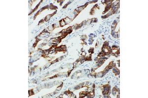 Anti-CYP2U1 antibody, IHC(P) IHC(P): Human Intestinal Cancer Tissue (CYP2U1 antibody  (C-Term))