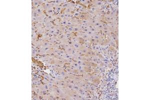 Immunohistochemical analysis of E on paraffin-embedded Human hepato carcinoma tissue. (beta 2 Adrenergic Receptor antibody  (AA 345-373))