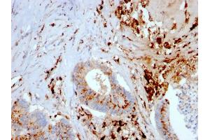 Formalin-fixed, paraffin-embedded human Liver Carcinoma and Macrophages stained with Cathepsin D Mouse Monoclonal Antibody (CTSD/3082). (Cathepsin D antibody  (AA 104-250))