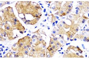 Immunohistochemistry of paraffin-embedded Human gastric cancer using BMPR1B Polyclonal Antibody at dilution of 1:200 (40x lens). (BMPR1B antibody)
