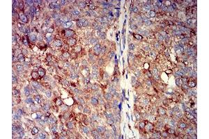 Immunohistochemical analysis of paraffin-embedded bladder cancer tissues using CHRNA7 mouse mAb with DAB staining.