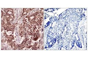 Immunohistochemical analysis of paraffin-embedded human breast carcinoma tissue, using NFκB-p105/p50 (Phospho-Ser927) antibody (E011312). (NFKB1 antibody  (pSer927))