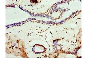 Immunohistochemistry of paraffin-embedded human breast cancer using ABIN7160457 at dilution of 1:100 (MOG antibody  (AA 30-154))