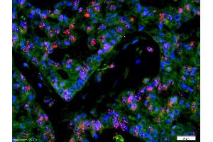 Formalin-fixed and paraffin-embedded human rectal carcinoma labeled with Anti-CDCA5/Sororin Polyclonal Antibody, Unconjugated (ABIN872622) 1:200, overnight at 4°C, The secondary antibody was Goat Anti-Rabbit IgG, Cy3 conjugated used at 1:200 dilution for 40 minutes at 37°C. (CDCA5 antibody  (AA 101-200))