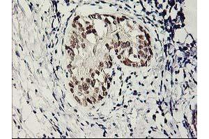 Immunohistochemical staining of paraffin-embedded Adenocarcinoma of Human breast tissue using anti-SERPINB13 mouse monoclonal antibody. (SERPINB13 antibody)