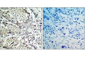 Immunohistochemistry analysis of paraffin-embedded human breast carcinoma tissue, using MKK6 (Ab-207) Antibody.