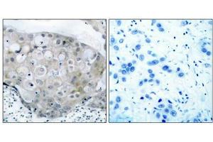 Immunohistochemical analysis of paraffin-embedded human breast carcinoma tissue using VEGFR2(Phospho-Tyr951) Antibody(left) or the same antibody preincubated with blocking peptide(right). (VEGFR2/CD309 antibody  (pTyr951))