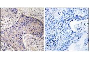 Immunohistochemistry analysis of paraffin-embedded human prostate carcinoma tissue, using ST6GAL1 Antibody. (ST6GAL1 antibody  (AA 171-220))