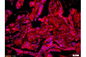 Formalin-fixed and paraffin-embedded human rectal carcinoma labeled with Anti-GTSE-1 Polyclonal Antibody, Unconjugated (ABIN741405) 1:200, overnight at 4°C, The secondary antibody was Goat Anti-Rabbit IgG, Cy3 conjugated used at 1:200 dilution for 40 minutes at 37°C. (GTSE1 antibody  (AA 651-739))