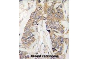 Formalin-fixed and paraffin-embedded human breast carcinoma tissue reacted with CASC3 Antibody (C-term) (ABIN391401 and ABIN2841404) , which was peroxidase-conjugated to the secondary antibody, followed by DAB staining. (CASC3 antibody  (AA 206-236))