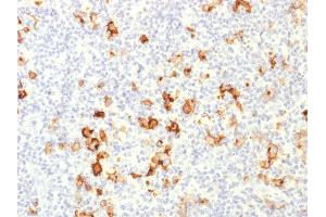 Formalin-fixed, paraffin-embedded human Hodgkin's Lymphoma stained with CD15 Rabbit Polyclonal Antibody. (CD15 antibody)