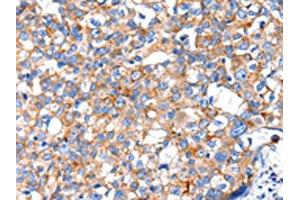 The image on the left is immunohistochemistry of paraffin-embedded Human breast cancer tissue using ABIN7130018(KLK15 Antibody) at dilution 1/15, on the right is treated with fusion protein. (Kallikrein 15 antibody)