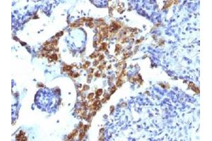 Immunohistochemical staining (Formalin-fixed paraffin-embedded sections) of human lung adenocarcinoma with NAPSA monoclonal antibody, clone NAPSA/1239 . (NAPSA antibody)