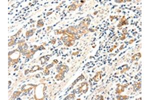 The image on the left is immunohistochemistry of paraffin-embedded Human gastric cancer tissue using ABIN7192279(SCN2A Antibody) at dilution 1/25, on the right is treated with synthetic peptide. (SCN2A antibody)