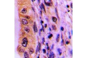 Immunohistochemical analysis of PHLDA3 staining in human lung cancer formalin fixed paraffin embedded tissue section. (PHLDA3 antibody)