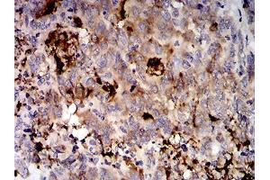 Immunohistochemical analysis of paraffin-embedded stomach cancer tissues using MUC5AC mouse mAb with DAB staining. (MUC5AC antibody  (AA 5528-5627))