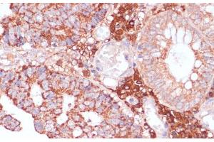 Immunohistochemistry of paraffin-embedded Human colon carcinoma using MZB1 Polyclonal Antibody at dilution of 1:100 (40x lens). (MZB1 antibody)