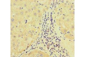 Immunohistochemistry of paraffin-embedded human liver cancer using ABIN7172513 at dilution of 1:100 (E2F1 antibody  (AA 133-362))