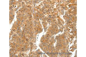 Immunohistochemistry of Human ovarian cancer using SCT Polyclonal Antibody at dilution of 1:60