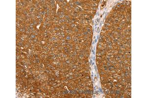 Immunohistochemistry of Human esophagus cancer using ABCC8 Polyclonal Antibody at dilution of 1:40 (ABCC8 antibody)