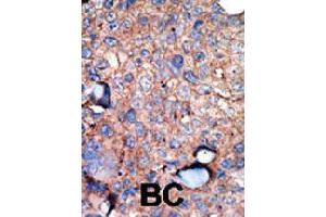 Formalin-fixed and paraffin-embedded human breast cancer tissue reacted with IKBKE polyclonal antibody  , which was peroxidase-conjugated to the secondary antibody, followed by AEC staining. (IKKi/IKKe antibody  (C-Term))