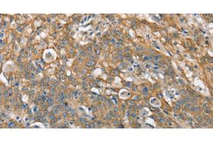 Immunohistochemistry of paraffin-embedded Human gastric cancer tissue using CSMD1 Polyclonal Antibody at dilution 1:40 (CSMD1 antibody)
