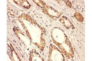 IHC-P: Rab8 antibody testing of human intestine cancer tissue (RAB8A antibody  (C-Term))