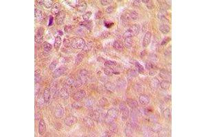 Immunohistochemical analysis of Laminin Receptor staining in human breast cancer formalin fixed paraffin embedded tissue section. (RPSA/Laminin Receptor antibody)