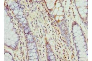 Immunohistochemistry of paraffin-embedded human colon cancer using ABIN7171417 at dilution of 1:100 (CCT5 antibody  (AA 1-270))