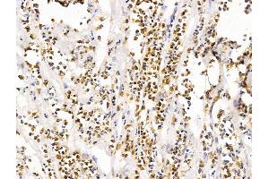 ABIN7094692 and ABIN7098743 at 1/100 staining Human pancreatic cancer by IHC-P. (LMX1A antibody  (Internal Region))