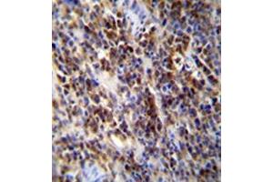 Immunohistochemistry analysis in formalin fixed and paraffin embedded human lymphoma reacted with PAPR9 Antibody (C-term) followed which was peroxidase conjugated to the secondary antibody followed byand DAB staining. (PARP9 antibody  (C-Term))