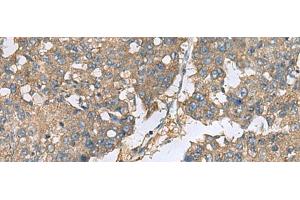Immunohistochemistry of paraffin-embedded Human liver cancer tissue using EIF1AX Polyclonal Antibody at dilution of 1:65(x200) (EIF1AX antibody)