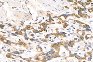 Immunohistochemistry analysis of paraffin-embedded human stomach cancer using MRPL12 (ABIN7074638) at dilution of 1: 1000