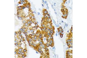 Immunohistochemistry of paraffin-embedded human liver cancer using B3 Rabbit mAb (ABIN7265774) at dilution of 1:100 (40x lens). (ATP1B3 antibody)