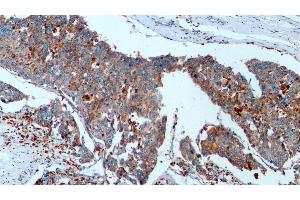 Detection of CTSD in Human Liver cancer Tissue using Monoclonal Antibody to Cathepsin D (CTSD) (Cathepsin D antibody  (AA 21-412))