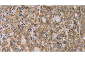 Immunohistochemistry of paraffin-embedded Human thyroid cancer tissue using RAB39B Polyclonal Antibody at dilution 1:45 (RAB39B antibody)