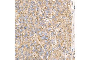 Immunohistochemistry of paraffin-embedded human liver cancer using Na+/K+-ATPase Rabbit pAb (ABIN6133568, ABIN6137299, ABIN6137301 and ABIN6223860) at dilution of 1:50 (40x lens). (ATP1A1 antibody  (AA 1-100))